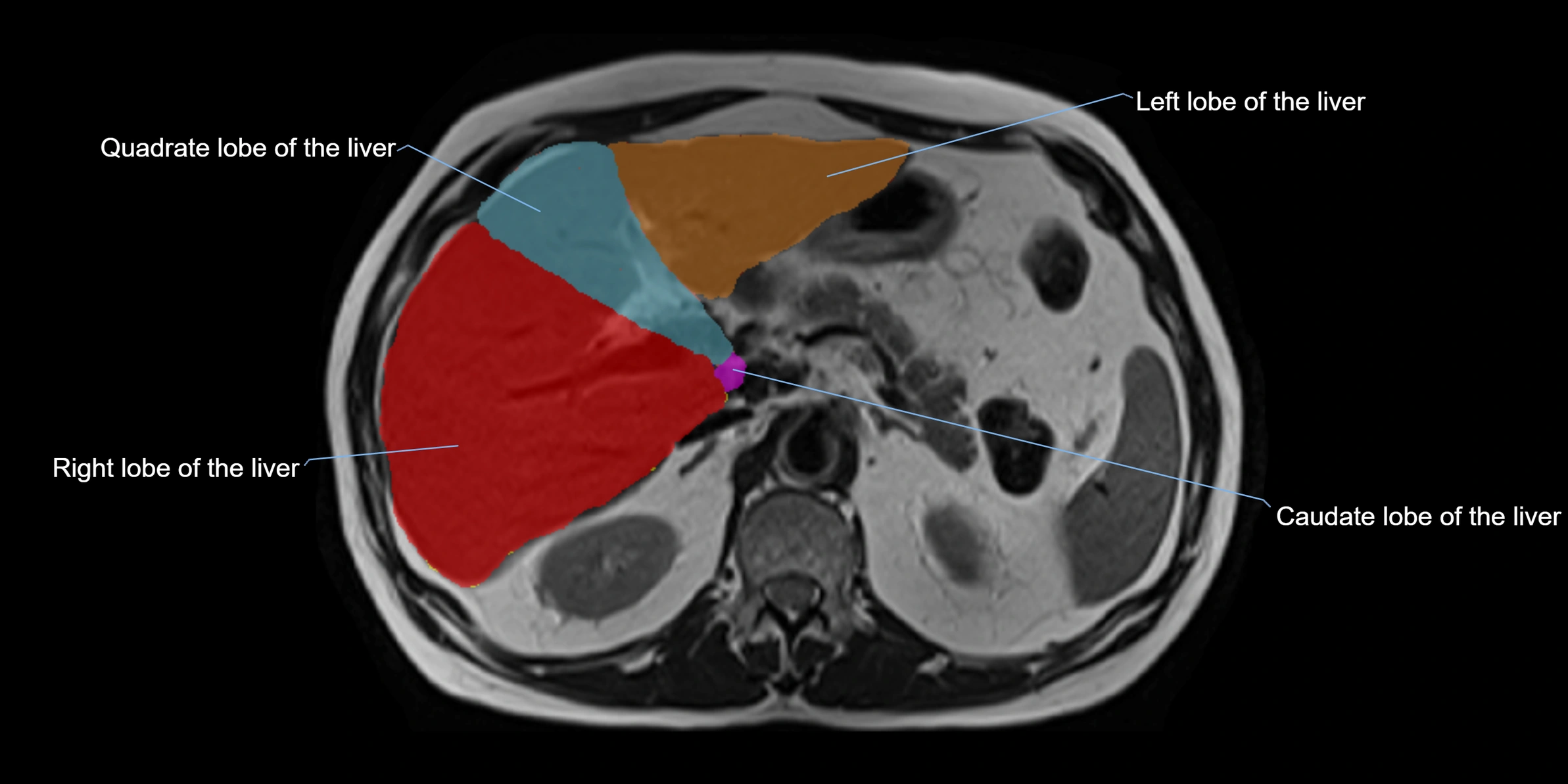MRI liver lobe axial cross sectional 3T radiology  image-img-00001-00015.webp